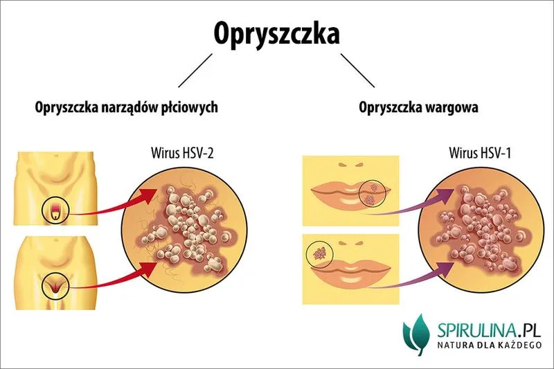 Opryszczka w toalecie
